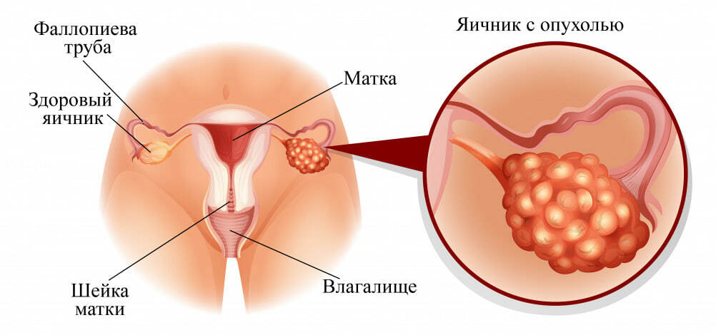 Лечение кандидозного вульвита в Москве, симптомы, причины, способы лечения — Клиника «Доктор рядом»