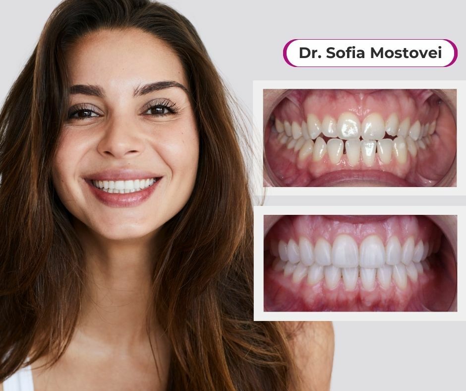 totul despre aparatul dentar