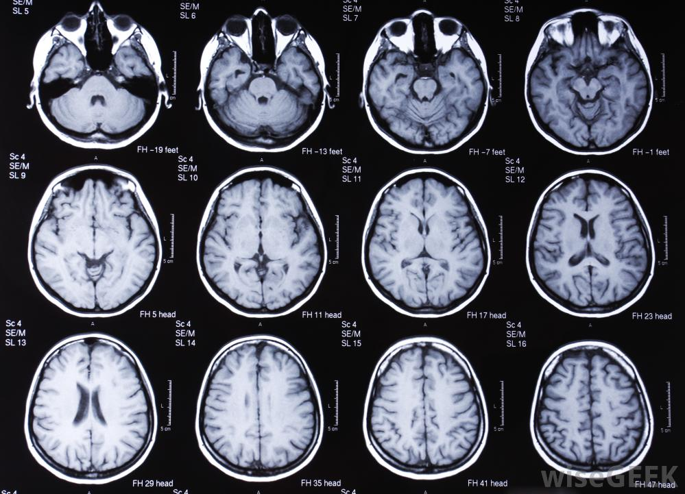 Хтэ это. Магнитно резонансные томограммы головного мозга. Мрт томограмма головного мозга. Снимки мрт головы норма. Опухоль головного мозга т1 т2.