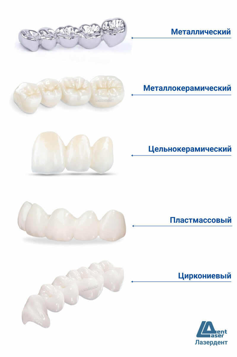 Четыре типа зубных мостов