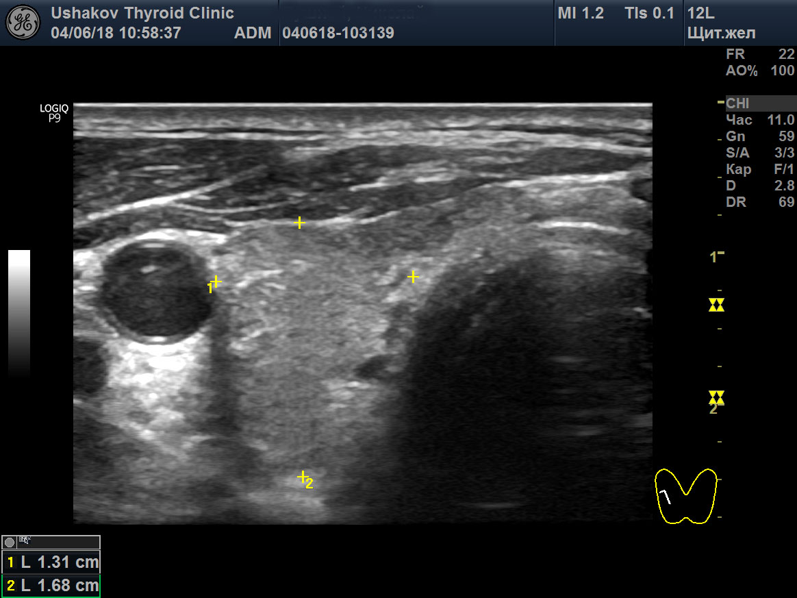 Узи щитовидной железы картинки