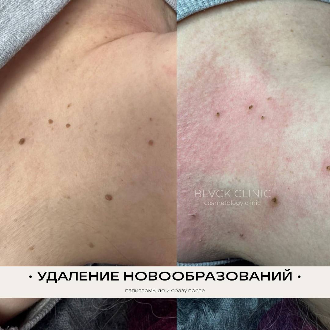 удаление папиллом на шее в клинике BLVCK CLINIC в Москве