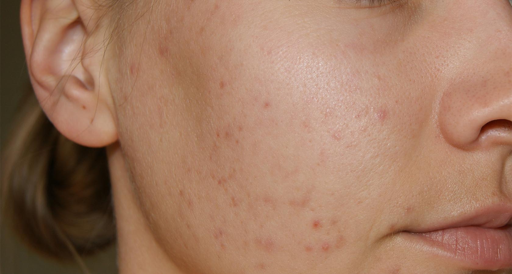 Рак кожи: симптомы и признаки