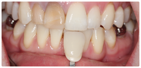 Зубы у детей черные: Понимание причин и решения проблемы потемнения молочных зубов у малышей