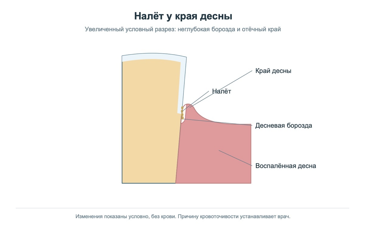 Налёт у края десны и воспаление тканей