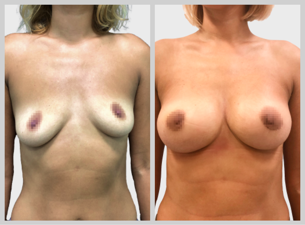 маммопластика увеличение груди импланты