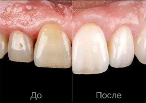 Лечение кариеса и отбеливание