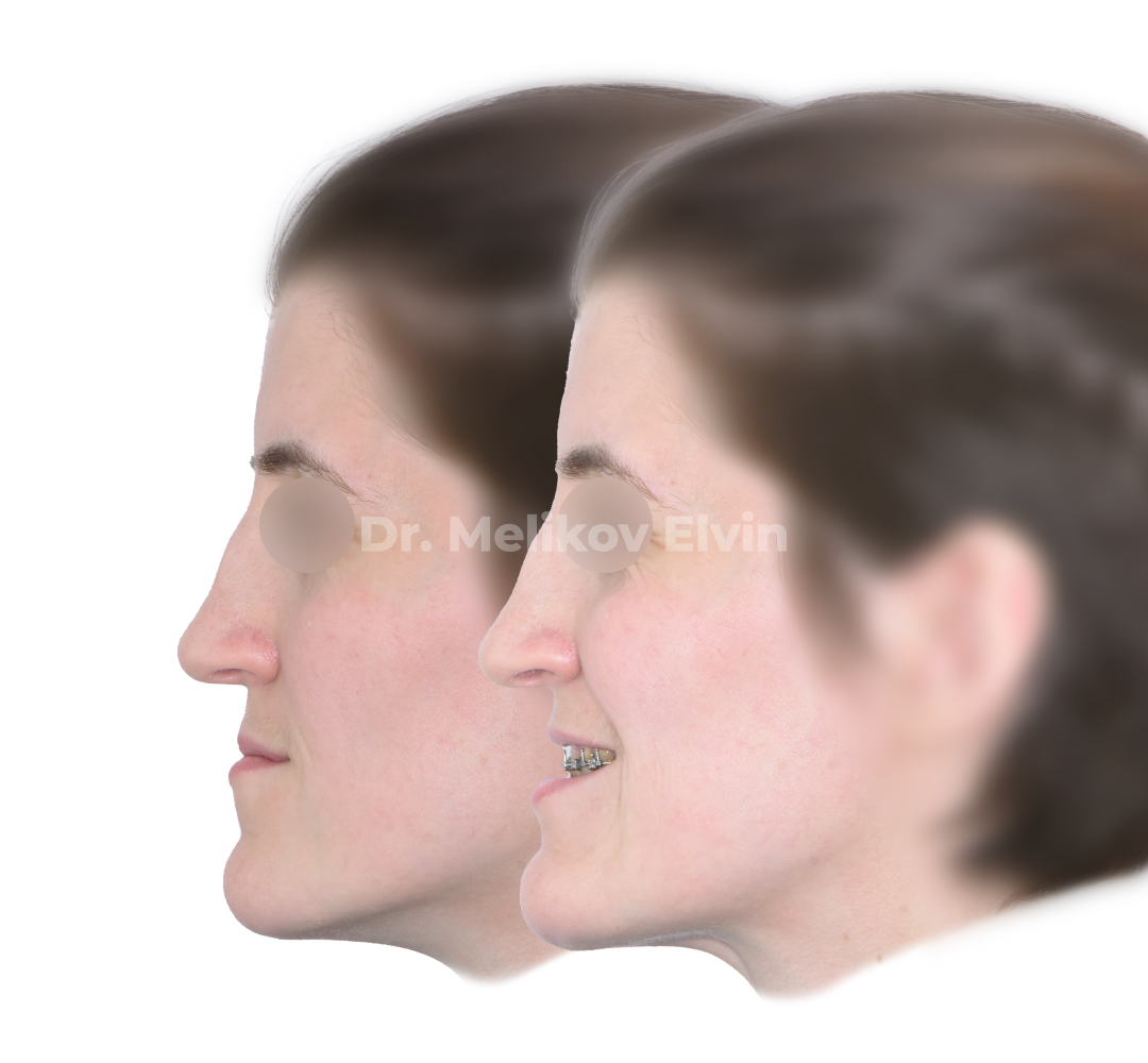 Мезиальный прикус