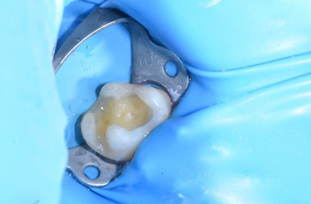 Устранение застревания пищи между зубами путём замены старых несостоятельных пломб