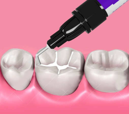 Герметизация фиссур 1 зуба дент сервис томск стоматология