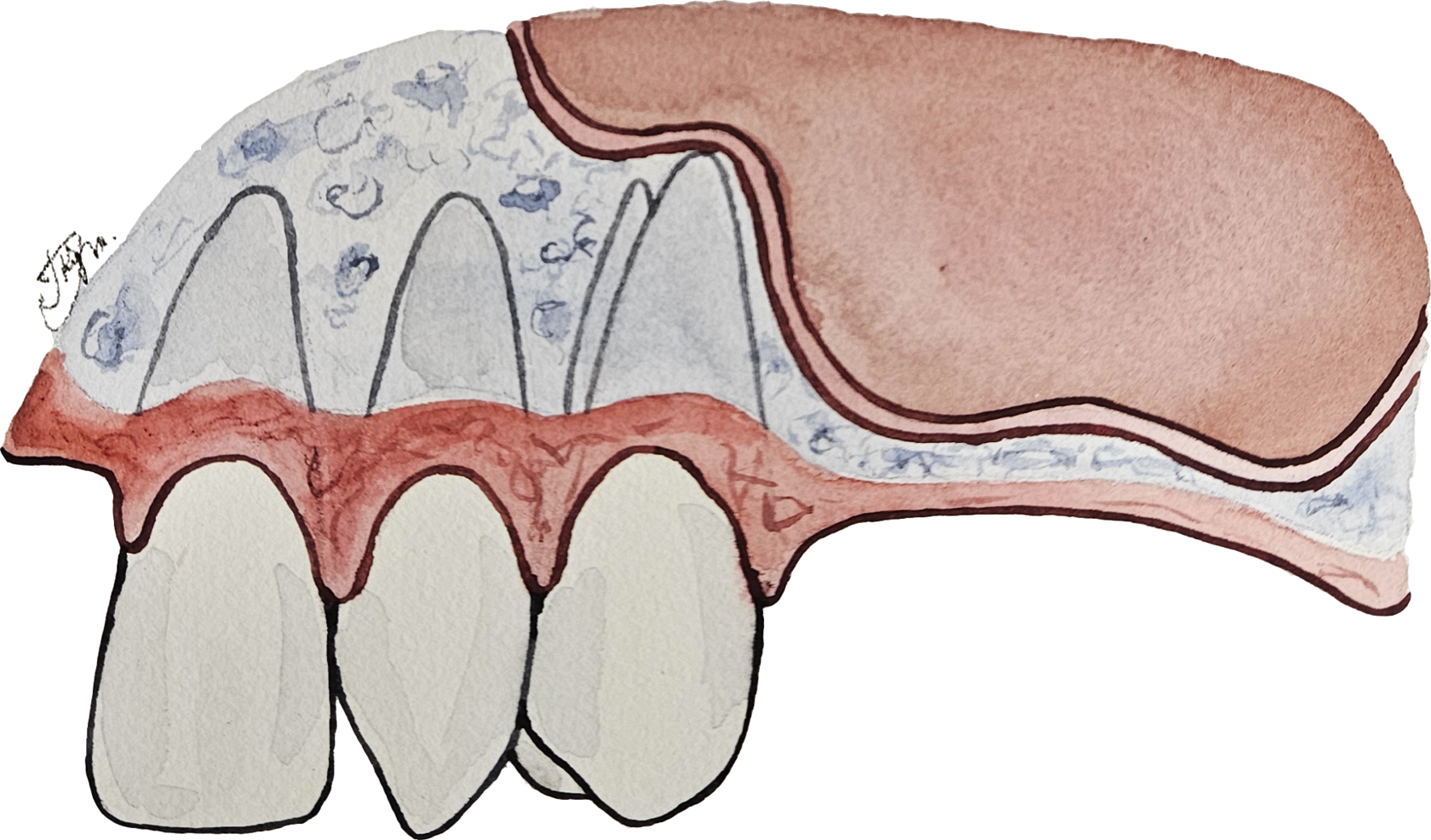 синус лифтинг