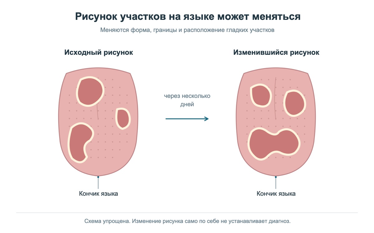 Изменение расположения участков на языке
