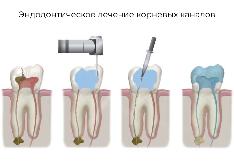 Как называется удаление