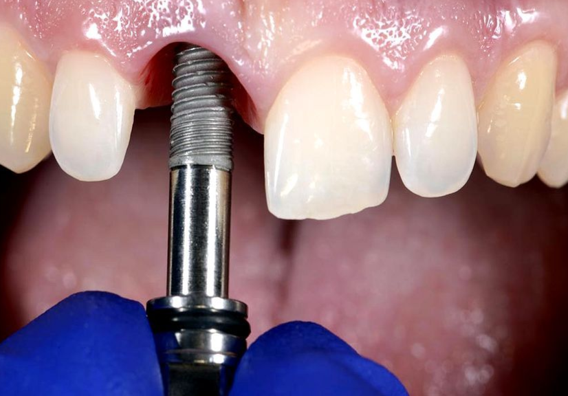 Причины, по которым остаются осколки зубов в десне