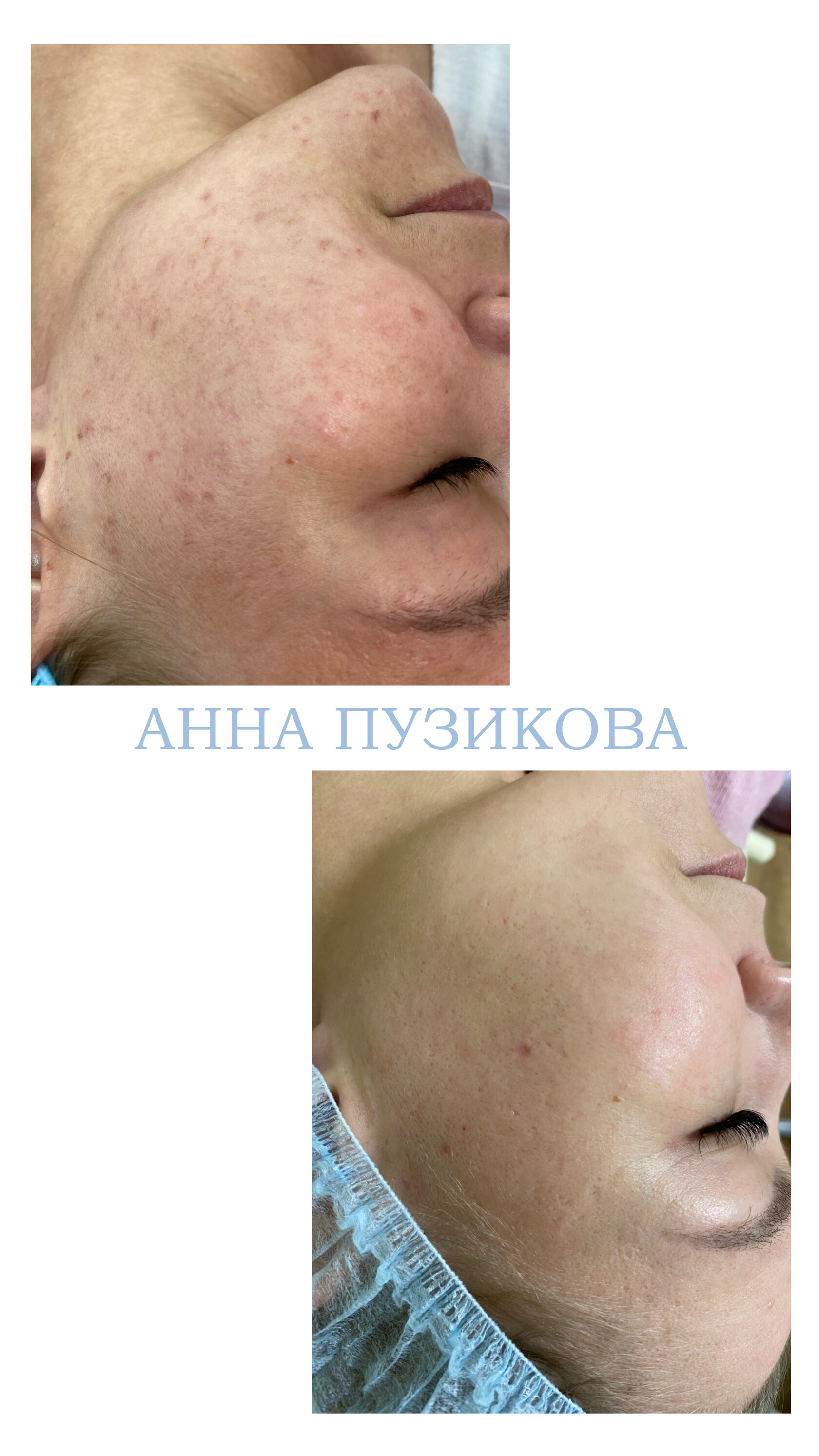 Результат удаления пигментных пятен после курса фототерапии ClearLight IPL — врач-косметолог Пузикова Анна Анатольевна, Санкт-Петербург