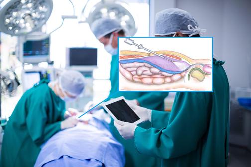 Герниопластика – цена операции грыжесечения удаления грыжи в Москве