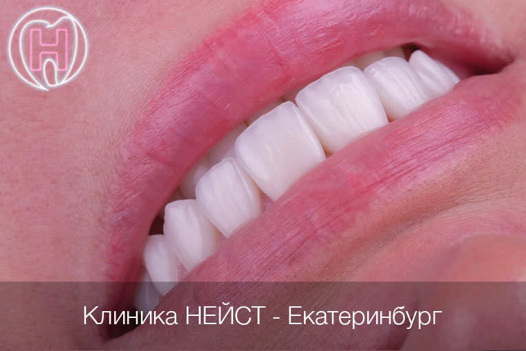 керамические виниры в Екатеринбурге цвет Блич 3 (Bleach 3)