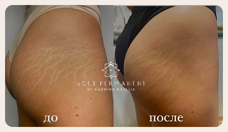 удаление растяжек москва до и после