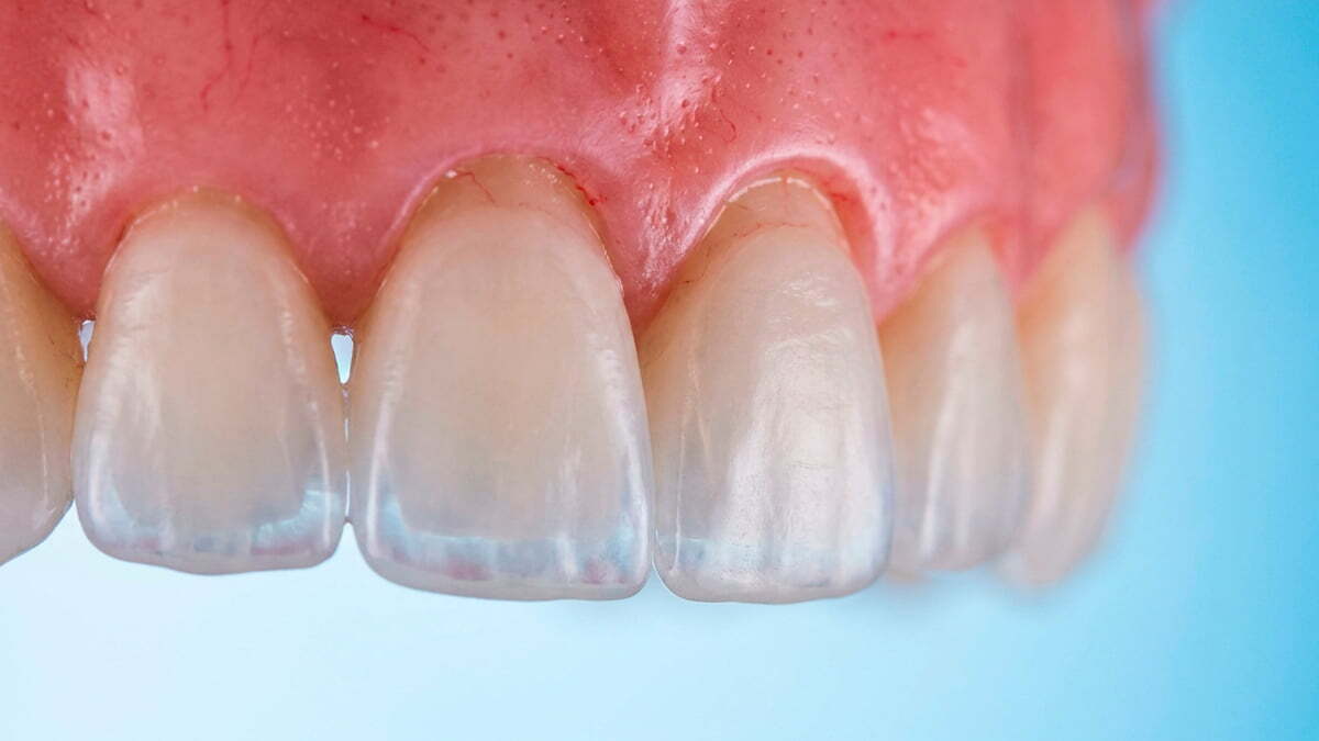 Виниры без обточки