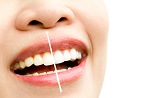 Dental filling