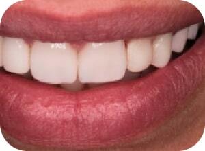 После имплантации