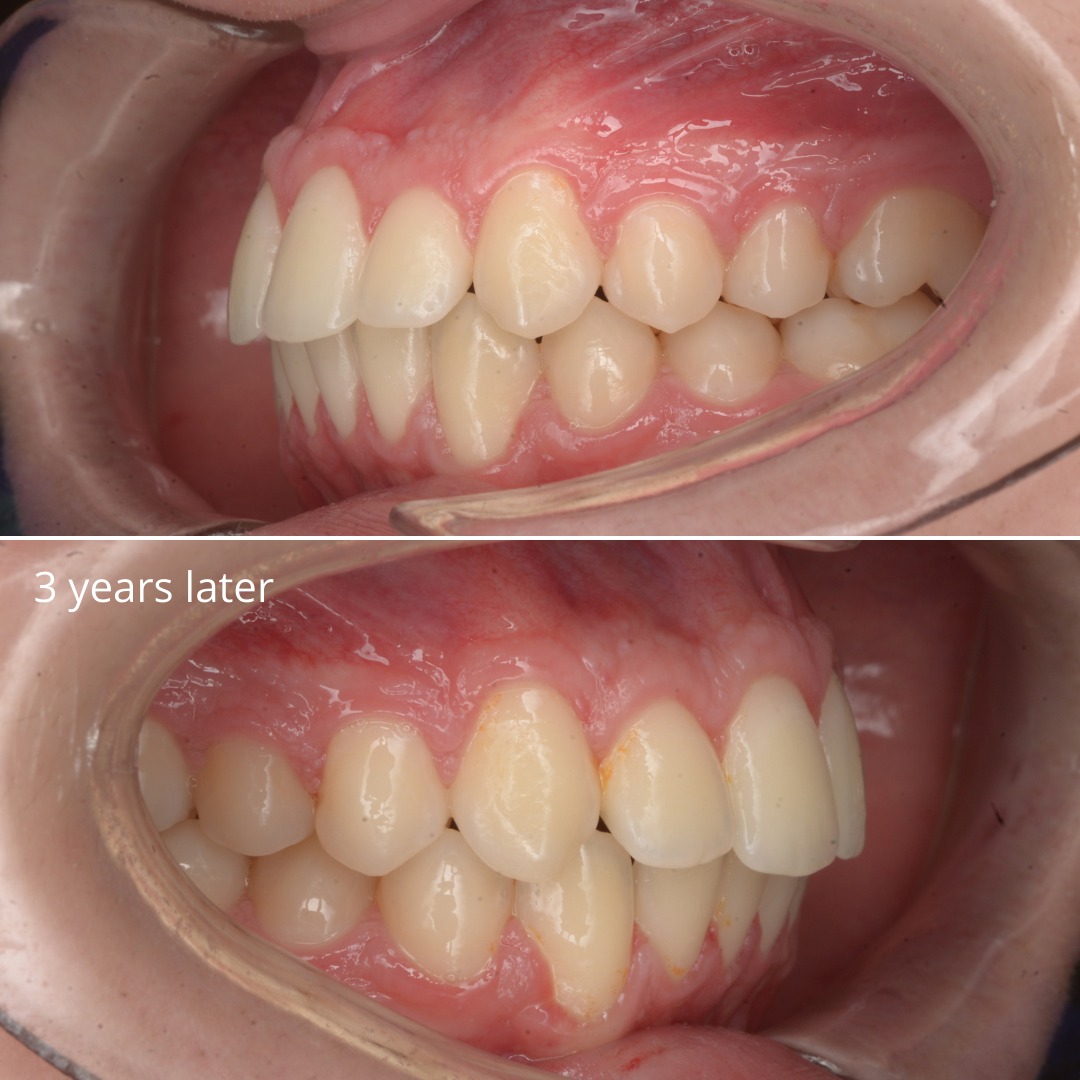 Stage of treatment shortly before completion, showing improved alignment — photo 5 of 6