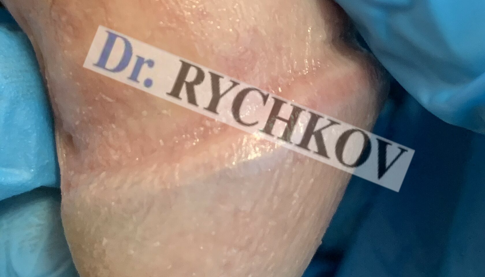 Гранулы Фордайса и перламутровые папулы полового члена