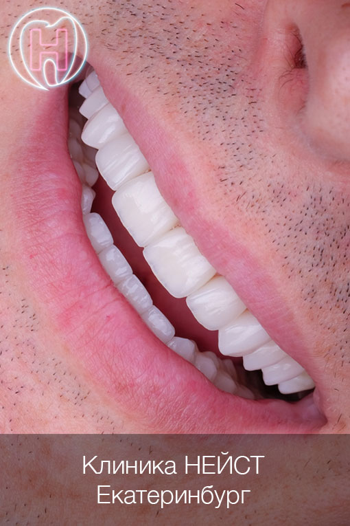 Премиальные мужские керамические виниры в Екатеринбурге цвет Блич 4/А1