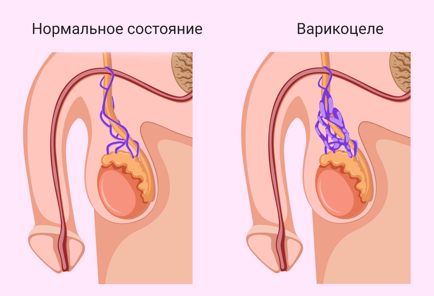 Лечение Варикоцеле и операция по Мармару в Одессе | Уролог андролог  Брезицкий Юрий Иосифович