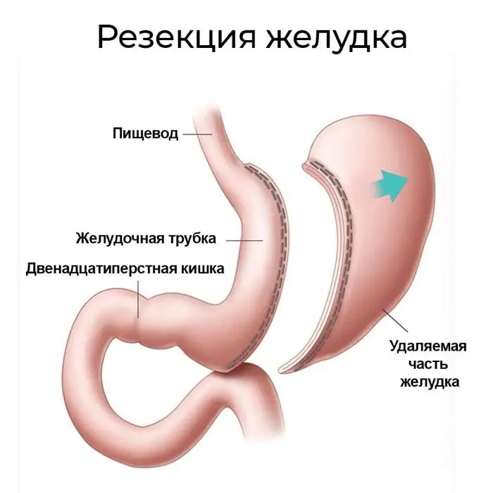 Подготовка к операции и анализы