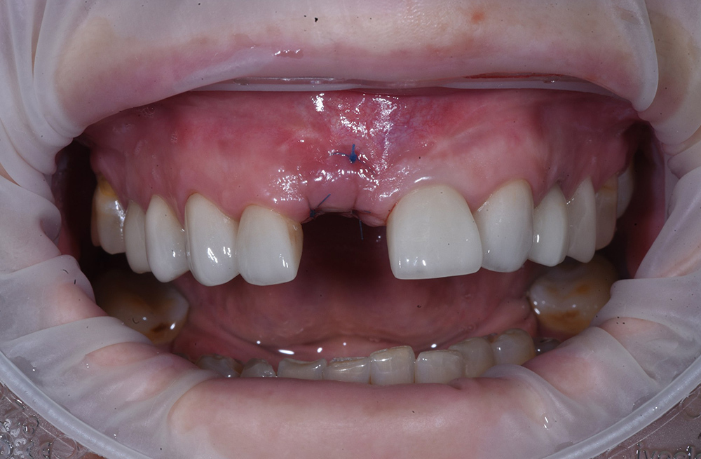 Имплантация Hiossen после удаления сломанного зуба