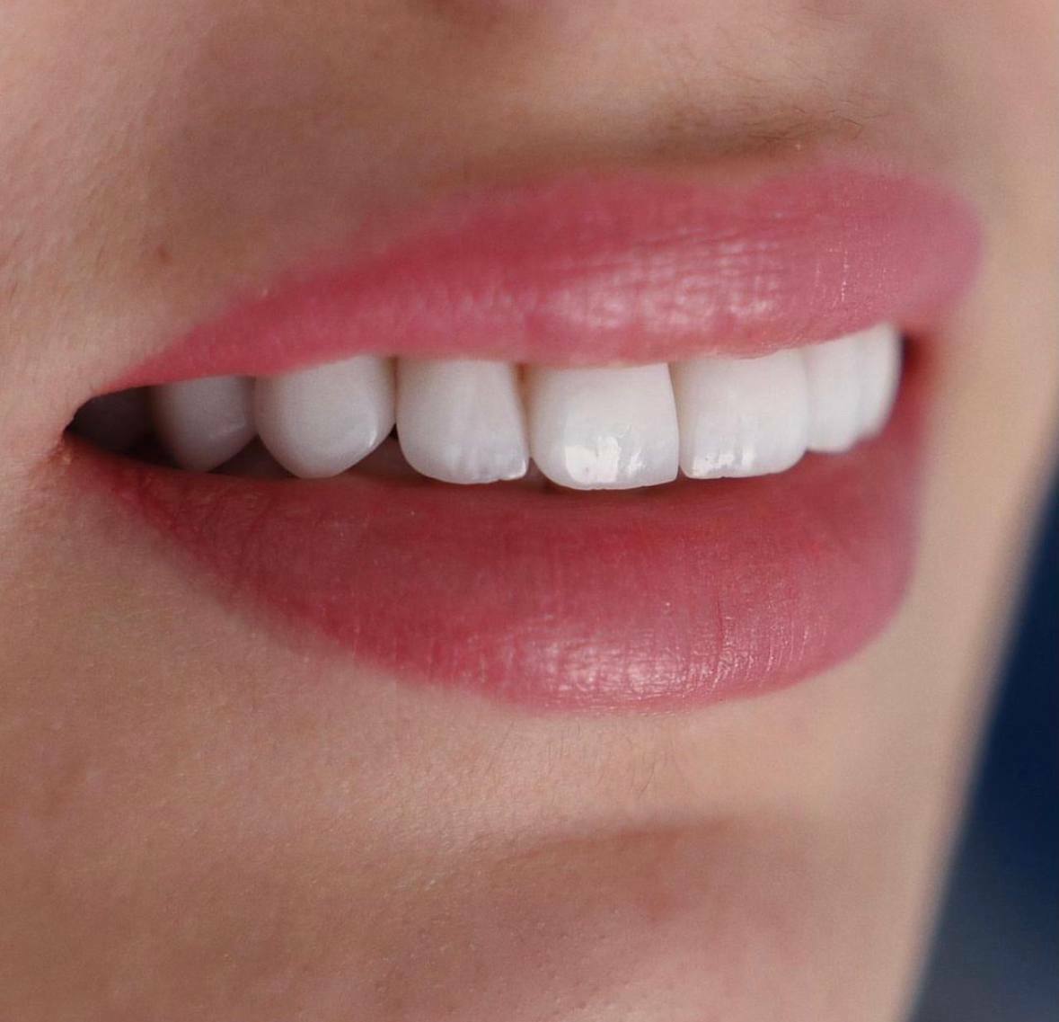 КВИЗ Имплантации зубов в Самаре за 1900 руб