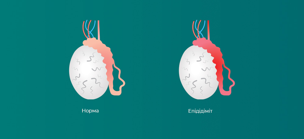 Епідідіміт. Діагностика та лікування у Києві на Печерську
