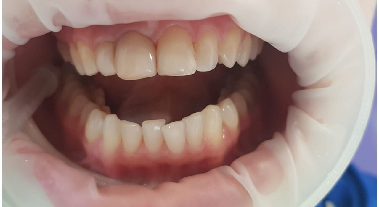Установлено 2 имплантата и 2 коронки из диоксид циркония. Врач Фаттахов М.Д.