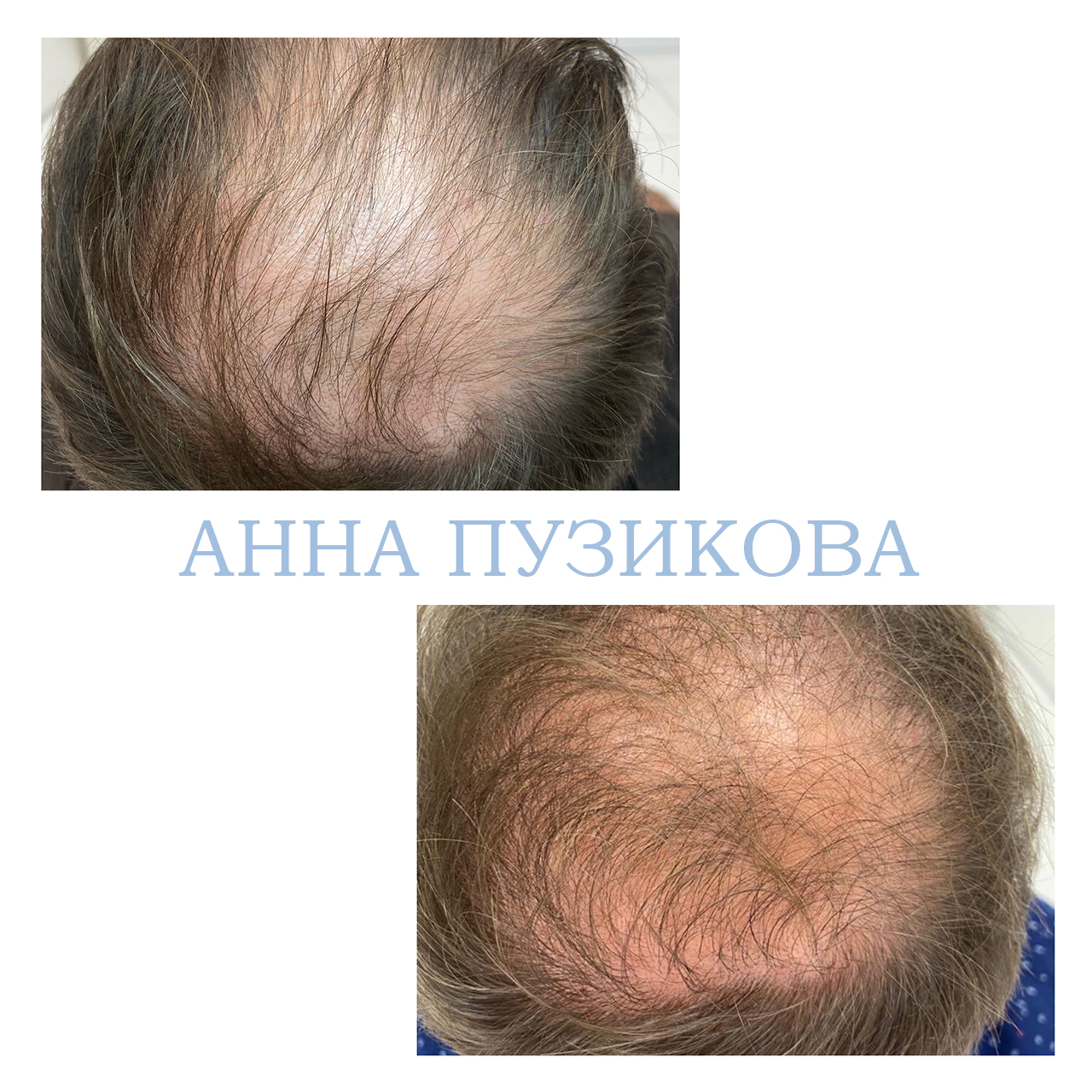 Результат лечения выпадения волос: повышение густоты, укрепление корней и улучшение состояния кожи головы — Прадус СПб.