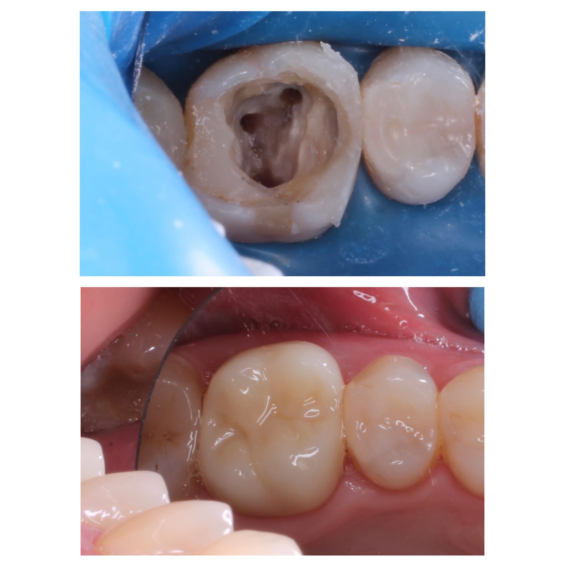 лечение зубов в чебоксарах,стоматология чебоксары, лечение кариеса в чебоксарах,стоматология отзывы, лечение зуба под микроскопом в чебоксарах
