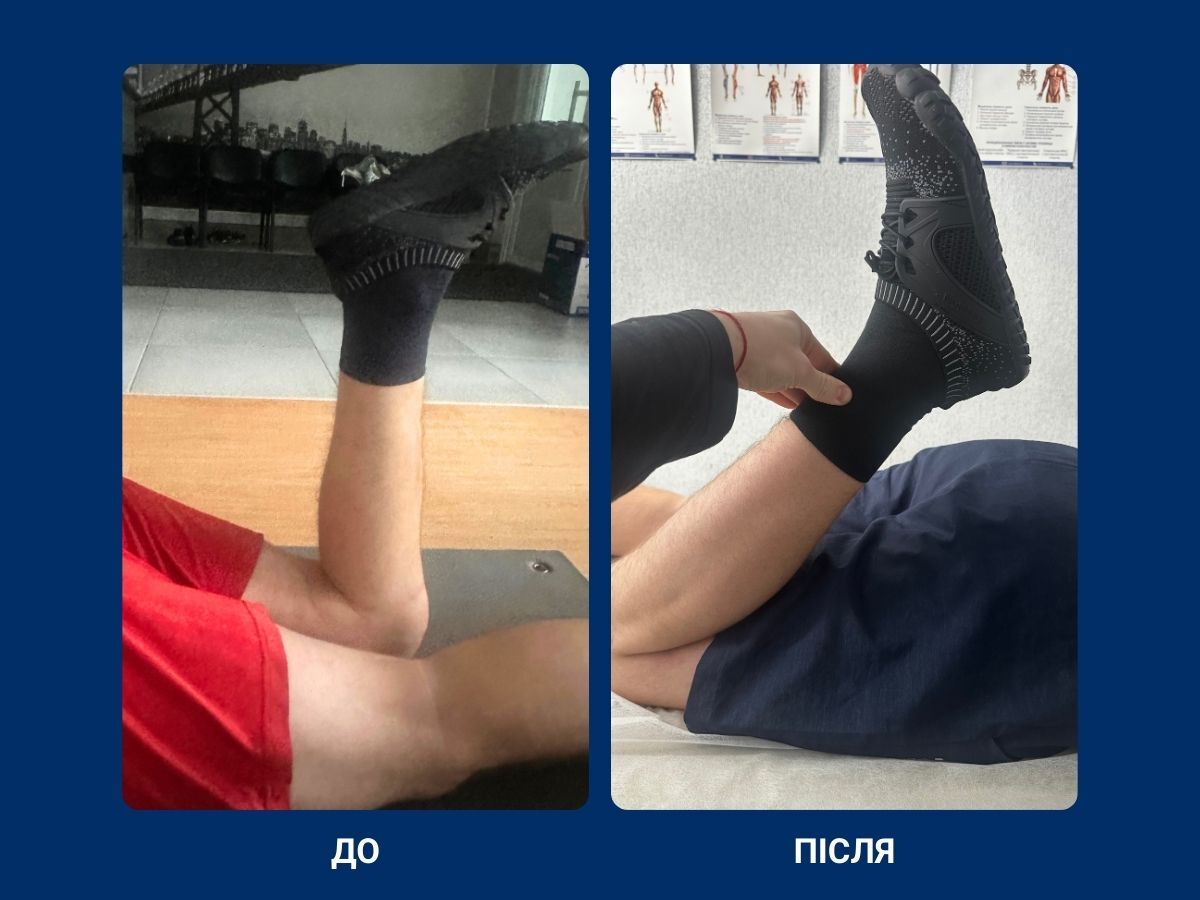 результати реабілітації до і після, коліно, зв'язки