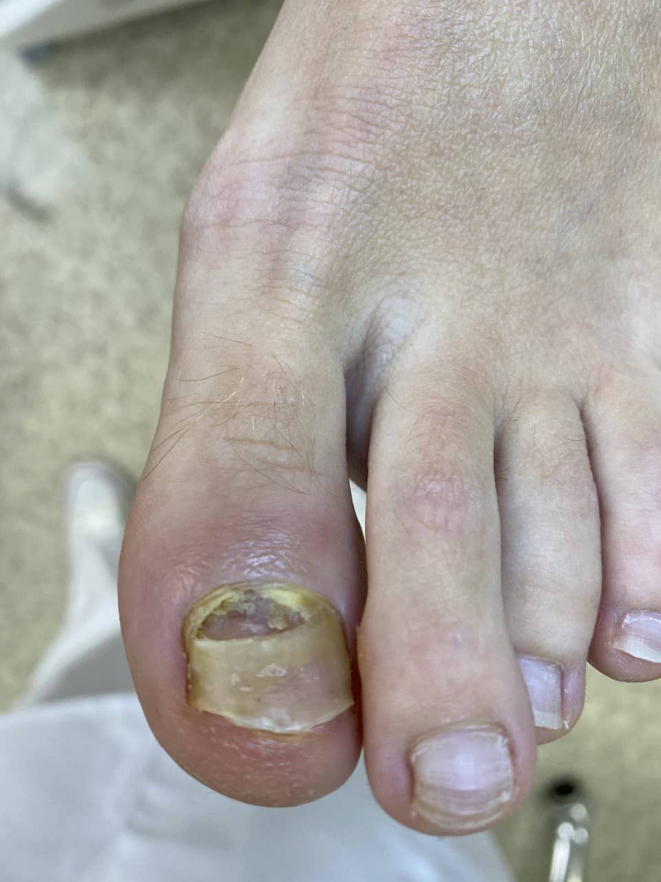 травма отходит ноготь