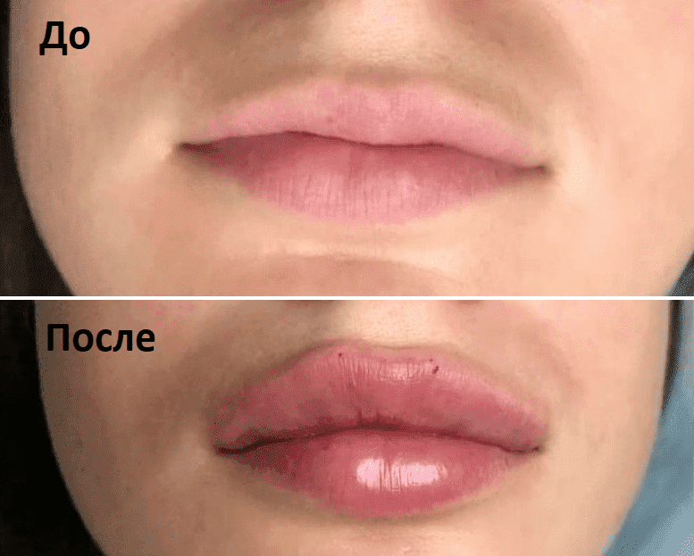 Формы губ для увеличения гиалуроновой кислотой фото и названиями