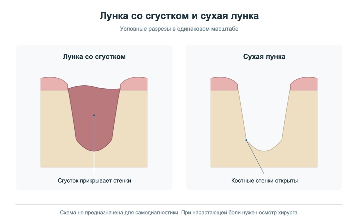 Схематичное сравнение лунки со сгустком и сухой лунки