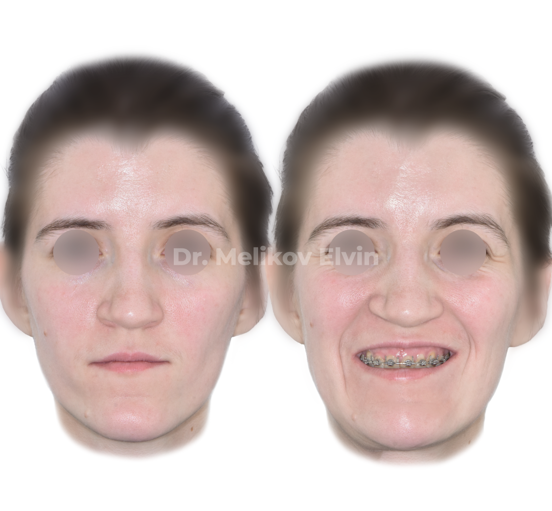 Мезиальный прикус