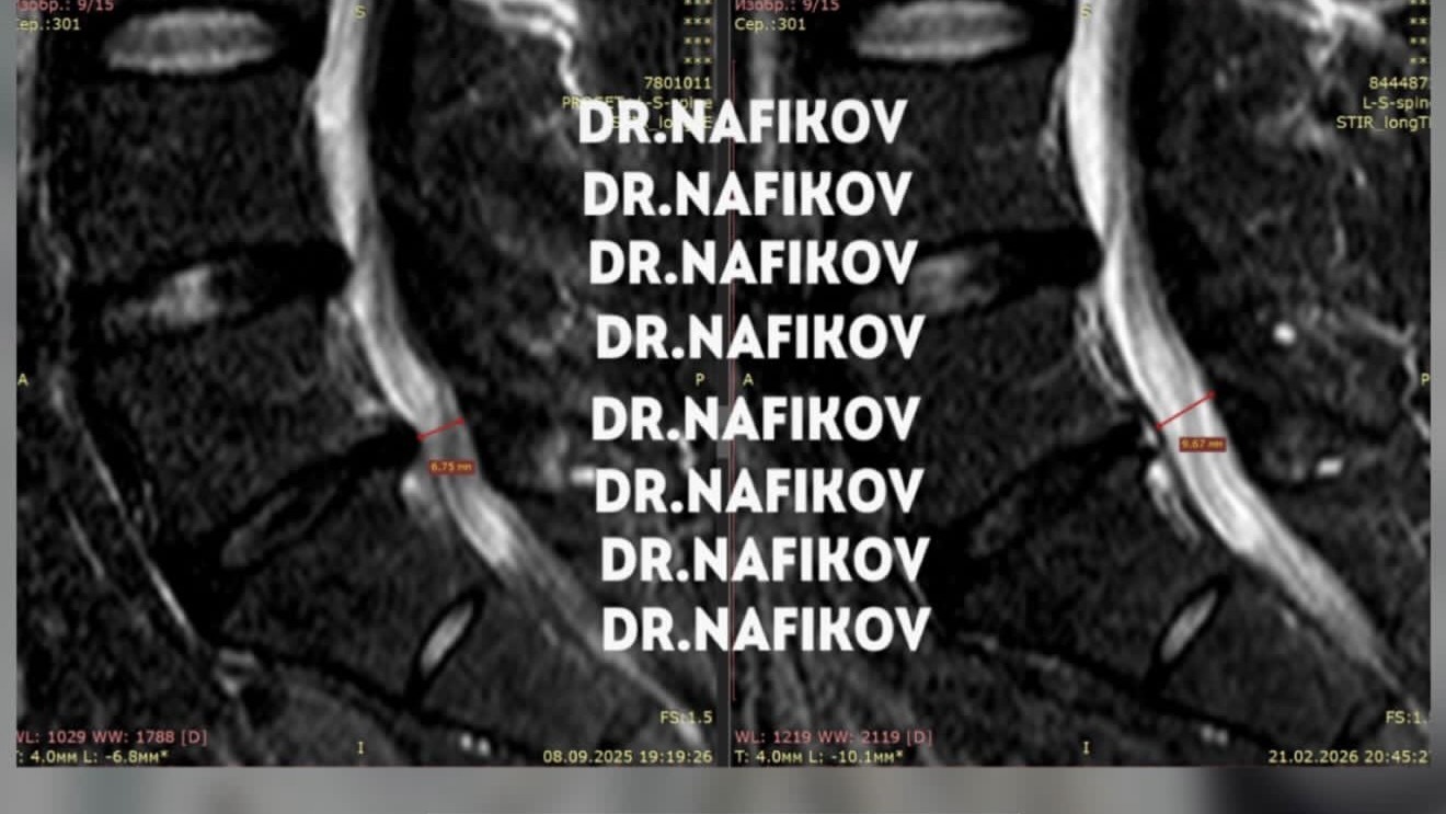МРТ до и после лечения, Пациент Л., 31 год