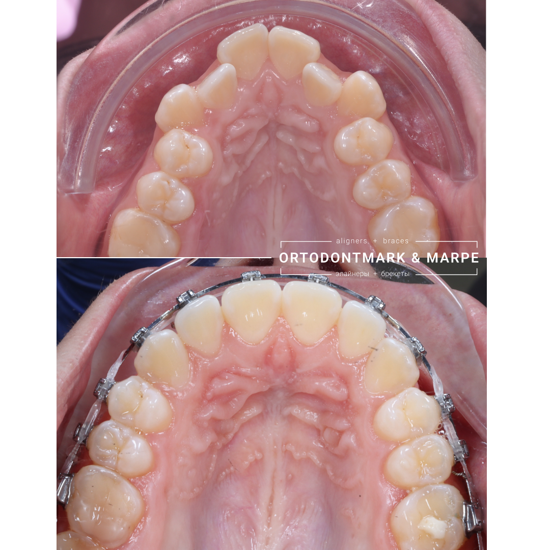 MARPE case result 18
