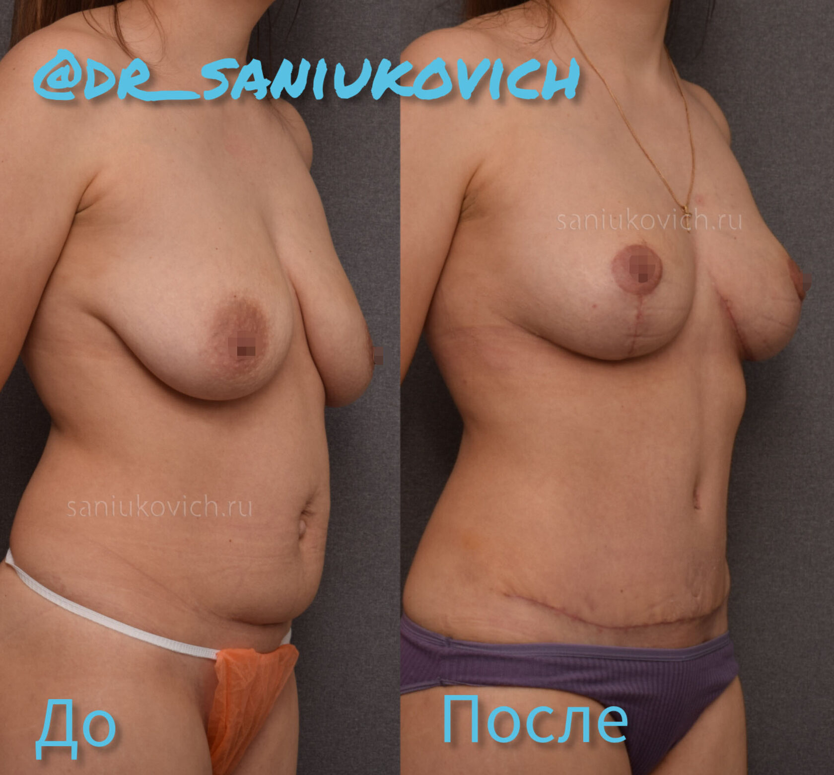 операция по подтяжке груди у женщин фото 6