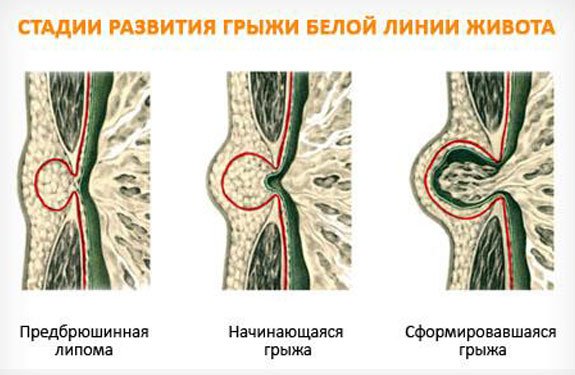 На какой день выписывают после удаления грыжи белой линии живота