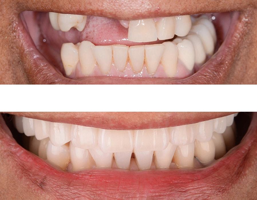 Реставрация зубов: фото до и после