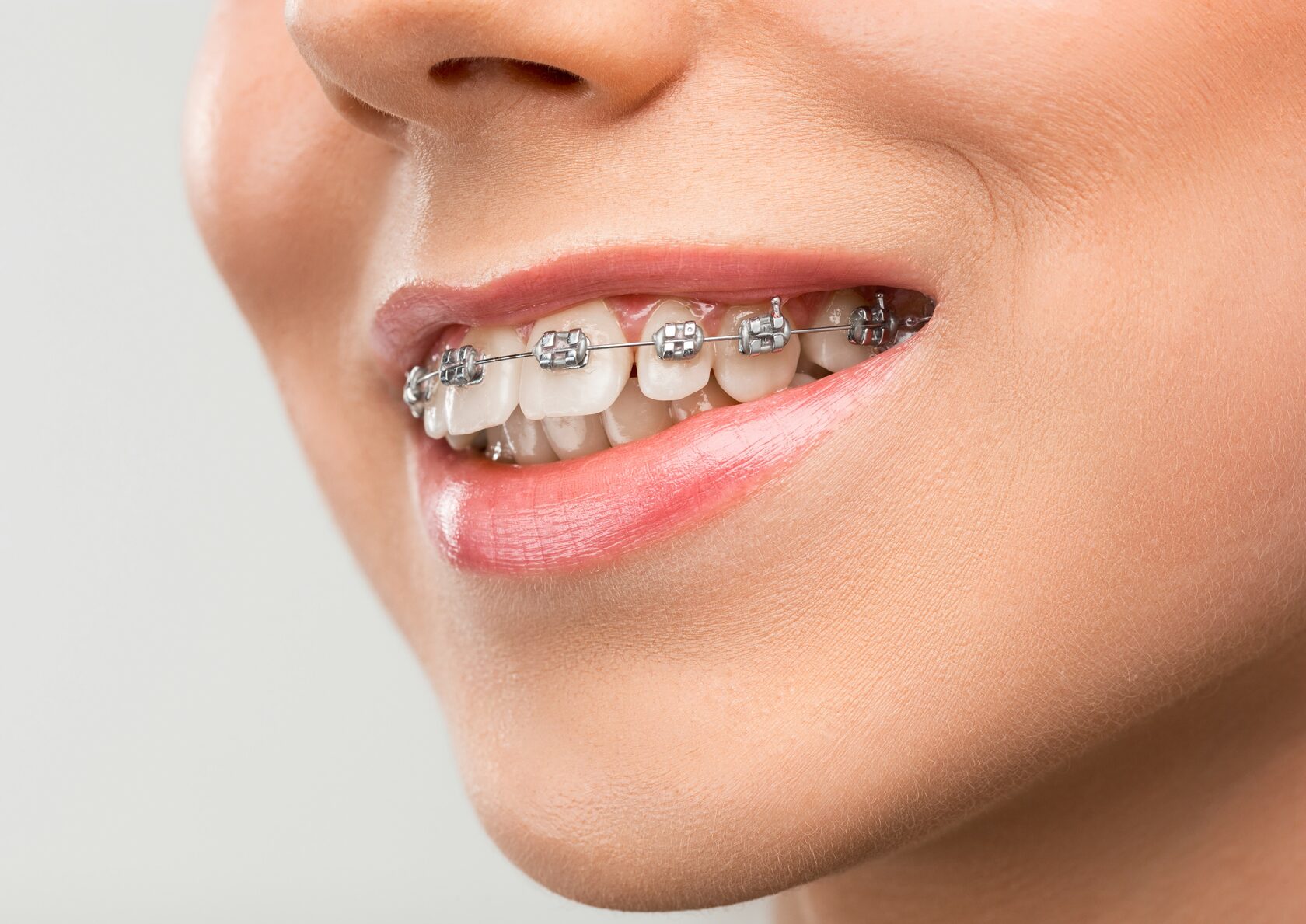 металлические брекеты. металлические брекеты. сколько стоят брекеты на 1 челюсть. сколько стоят брекеты на 1 челюсть. керамические брекеты.