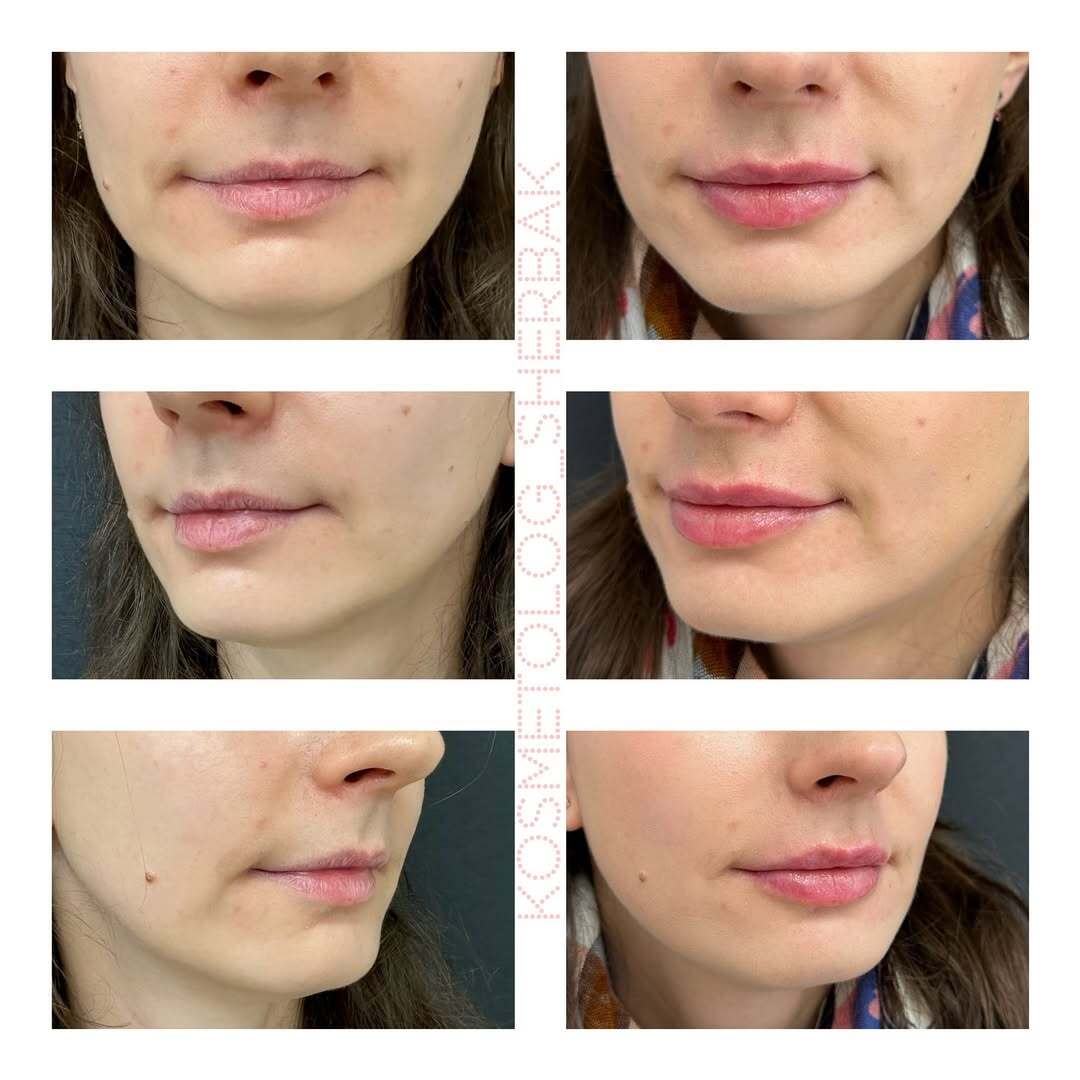 До и после контурной пластики губ. Увеличение объёма без утяжеления. PradusCOSMO, Васильевский остров