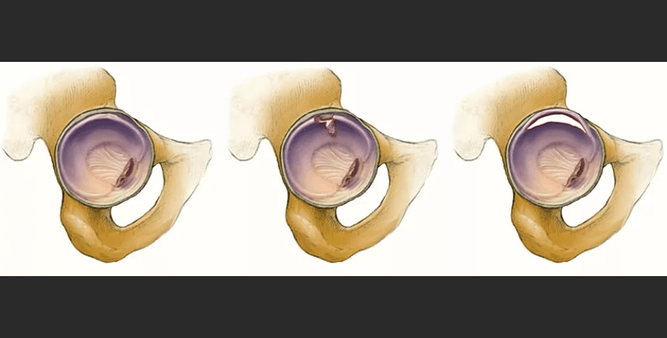 Губа сустава. Разрыв вертлужной губы тазобедренного сустава. Вертлужная губа тазобедренного сустава. Разрыв суставной губы вертлужной впадины тазобедренного сустава. Разрыв губы вертлужной впадины.