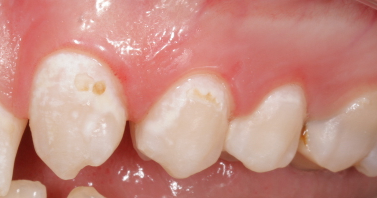 Почему крошатся зубы: причины и лечение